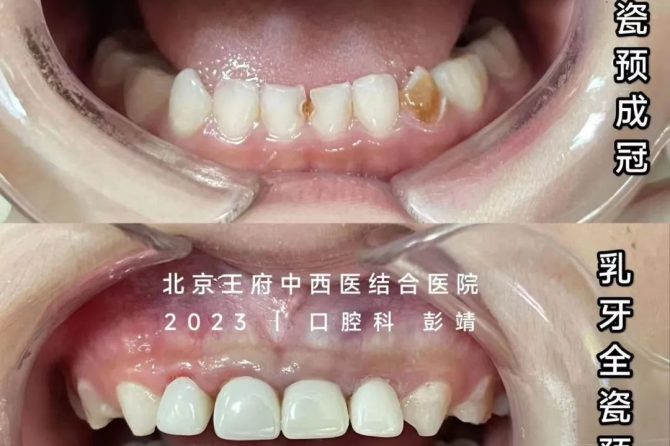 【新技术】我院口腔科采用NuSmile全瓷冠开展乳牙龋病治疗